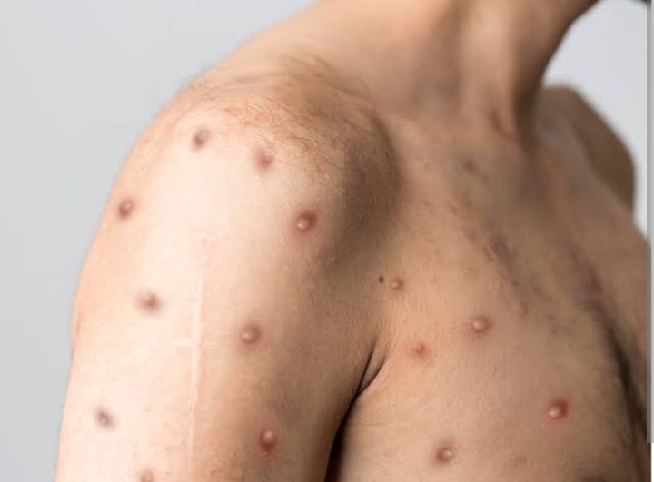 देश में मिला मंकी पॉक्स का पहला संदिग्ध केस, मरीज विदेश से लौटा था भारत